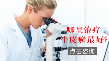 吉林牛皮癣医院怎么样